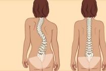 Prevention of scoliosis: how to avoid spinal deformity